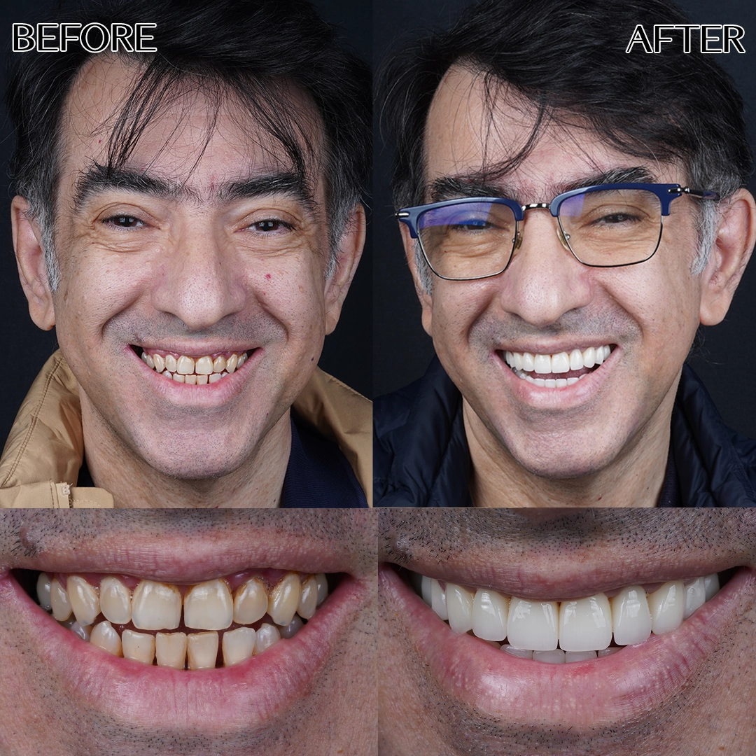 Zirconia crowns in Istanbul