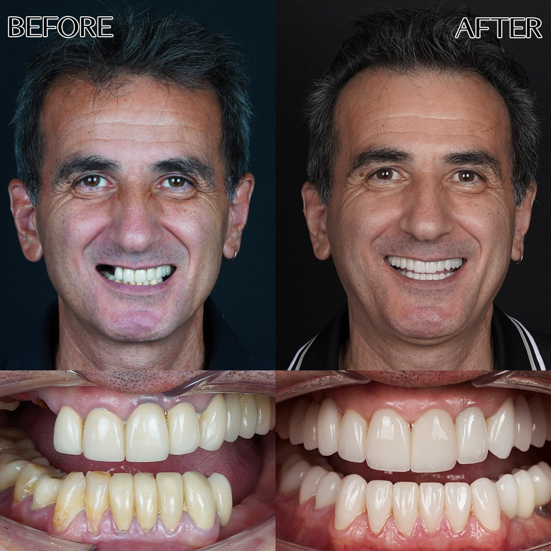 All on 4 dental implants in Turkey