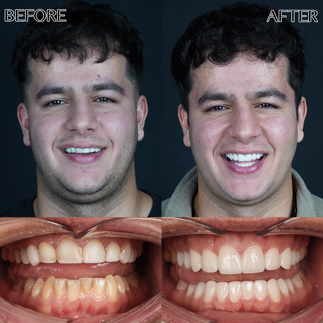 Zirconium crowns in Istanbul