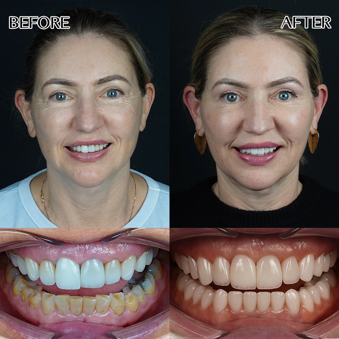 Digital smile design in Istanbul