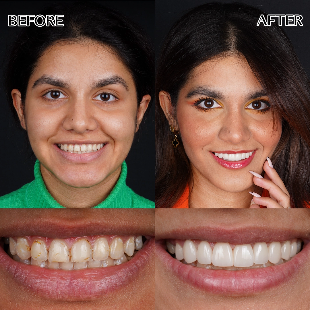 Dental veneers in Istanbul
