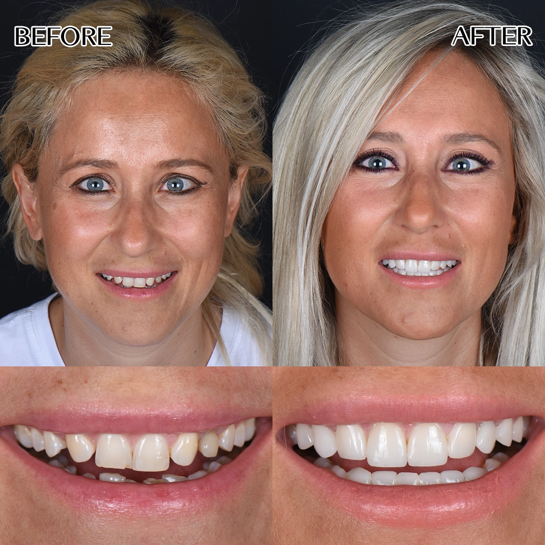 Full dental veneers in Istanbul
