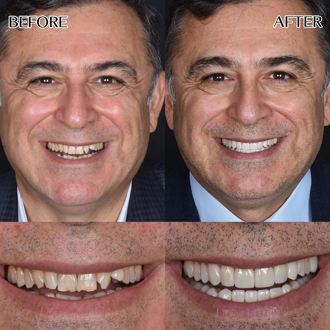 Hollywood Smile in Istanbul